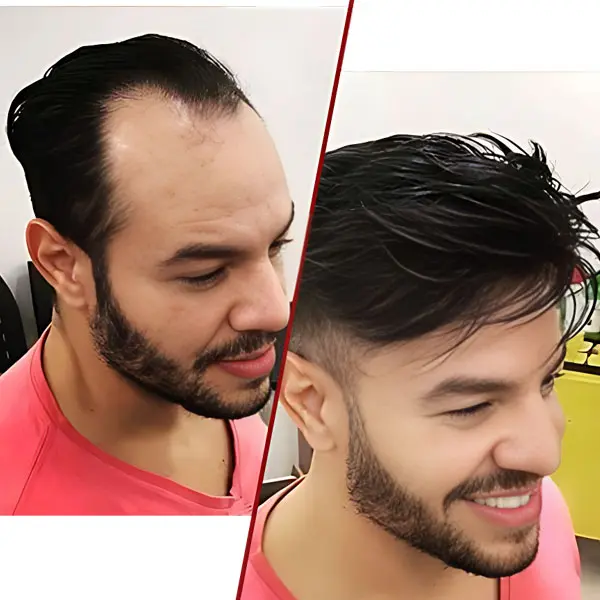 Hair Filling Service in India