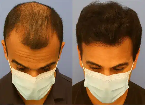 What is Hair weaving for men