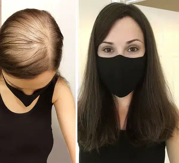 What Is Hair Fixing for Women in India