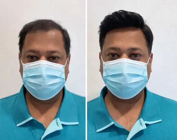 What Is Hair Taping Service by Smart Hair Fixing