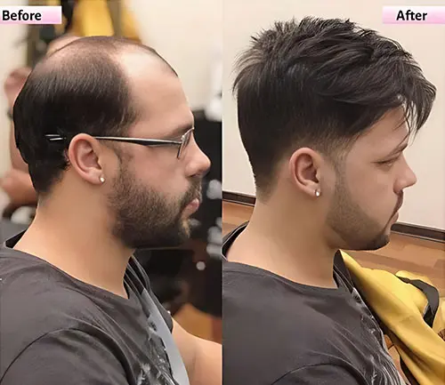 What Is Non Surgical Hair Replacement Service by Smart Hair Fixing