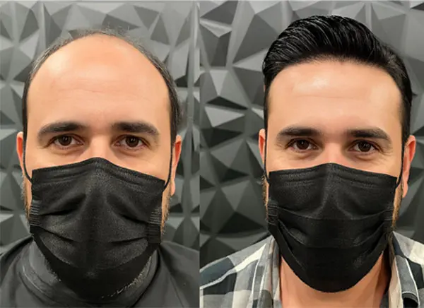 What Is Non-Surgical Hair Replacement for Men