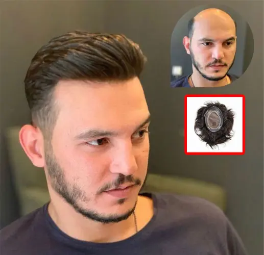 What is Hair Patch Service