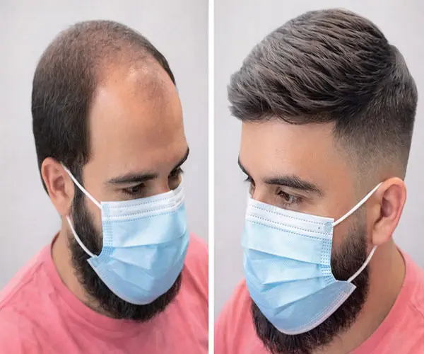 What is Hair system service in India