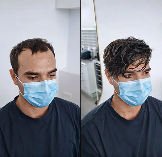 Hair Filling Service in India