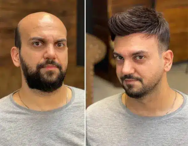 What Is Hair Bonding for Men