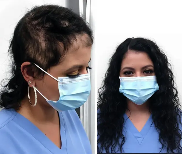 What Is Customized Wigs for Women by Smart Hair Fixing in India