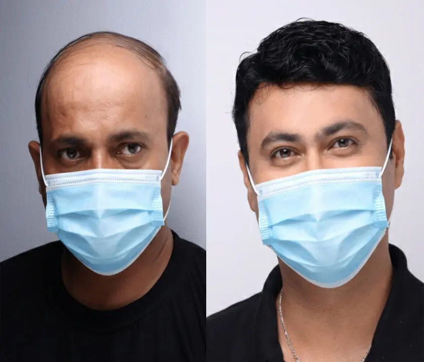 What Is Hair Filling for Men by Smart Hair Fixing