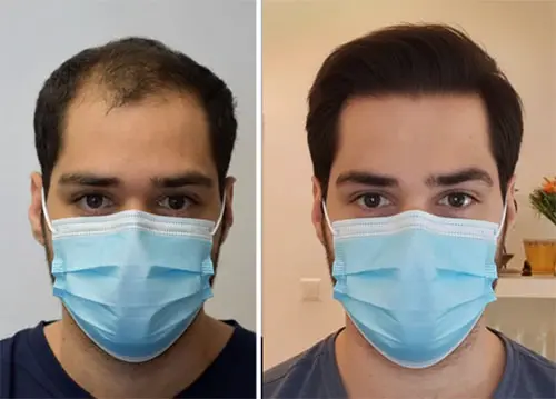 What Is Hair System for Men by Smart Hair Fixing